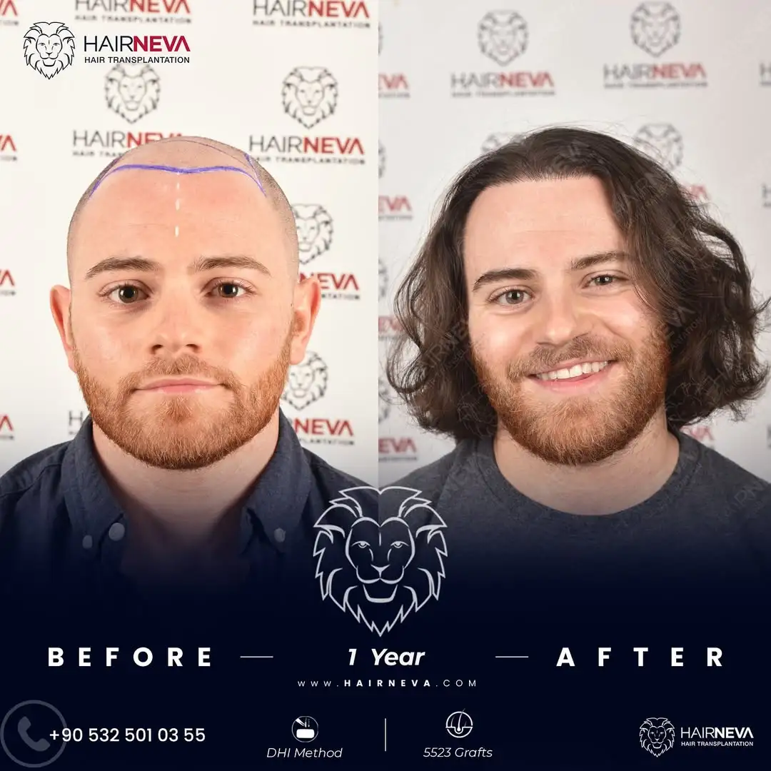 HairNeva Saç Ekim Merkezi İstanbul