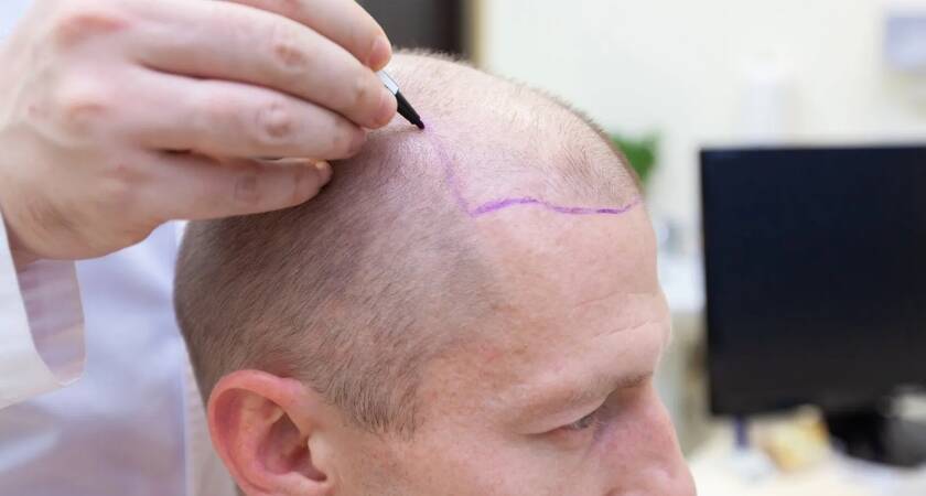 Antalya Saç Ekim Merkezleri