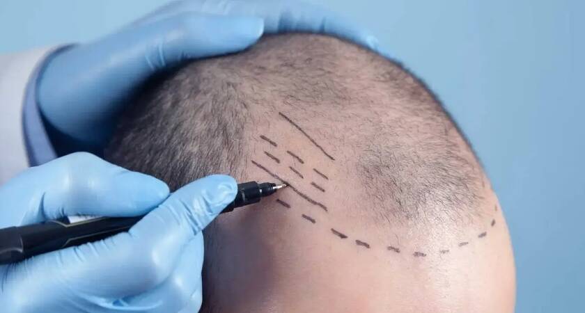 Bursa Saç Ekim Merkezleri