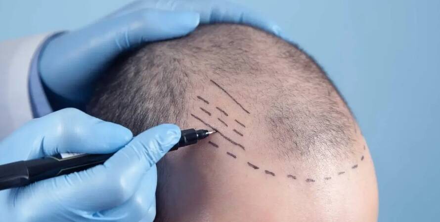 Bursa Saç Ekim Merkezleri