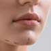 Jawline (Çene Dolgusu)